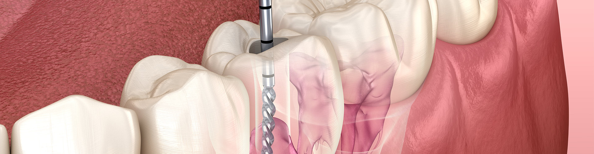 rendering of a lower jaw with a dental tool in the root canal.